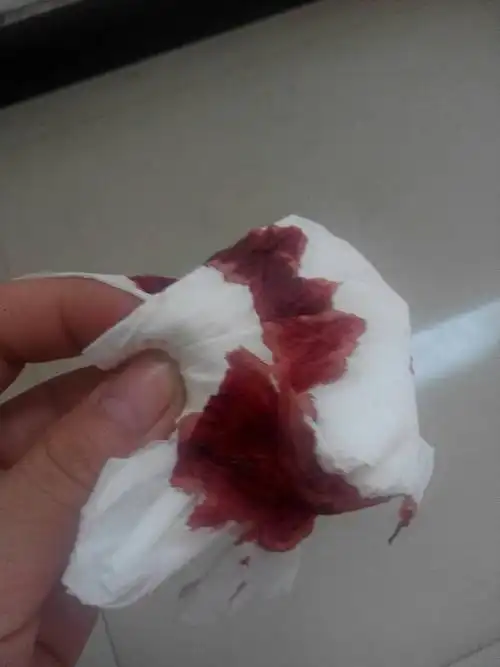 21岁女生流出暗红色血,是大姨妈?怀孕?还是流产?