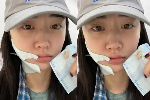 景甜拔牙脸肿表情委屈