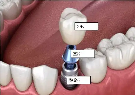 极简种植牙主要分为三部分:种植体,牙冠和愈合基台.