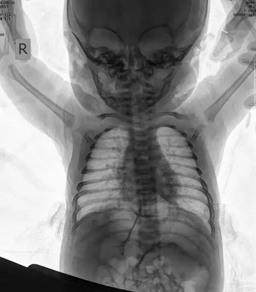 儿童胸片 大家帮忙分析一下!