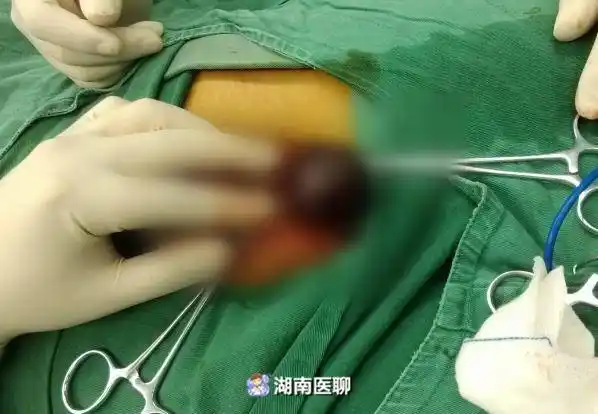 当心"蛋蛋"扭转!延误治疗或致切除