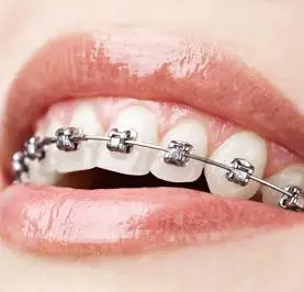 分享牙齿矫正要注意哪些