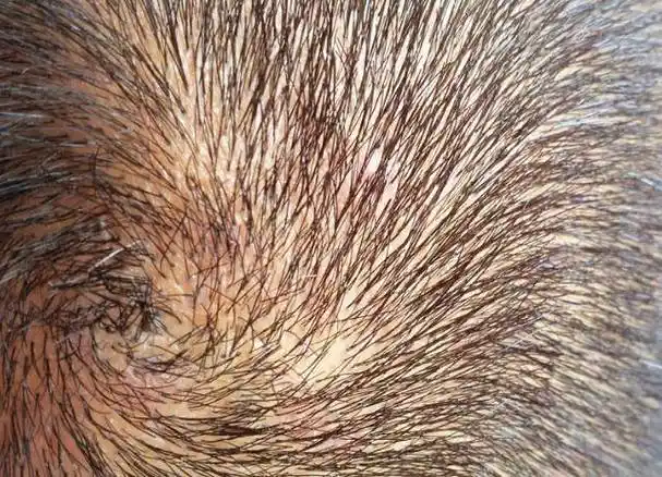 头皮里,老是长疙瘩和脓包,是咋回事了?