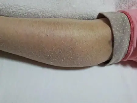 令我感到惊叹的是,p女士浑身上下的皮肤呈现爆裂的状态,而她自言