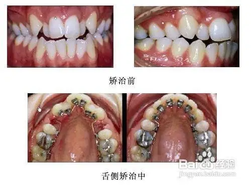 虎牙怎么治疗?
