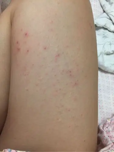 妊娠痒疹孕妇痒疹一到晚上就痒的不行,有宝妈这样吗?