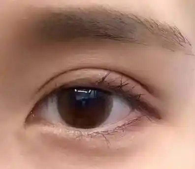 武汉割双眼皮#投稿:全切平扇双眼皮三个月了,淡妆就很能打了,全切双