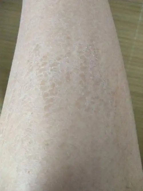 游完泳后小腿上出现鱼鳞片状的东西,而且腿上有淤青,求问是怎么回事