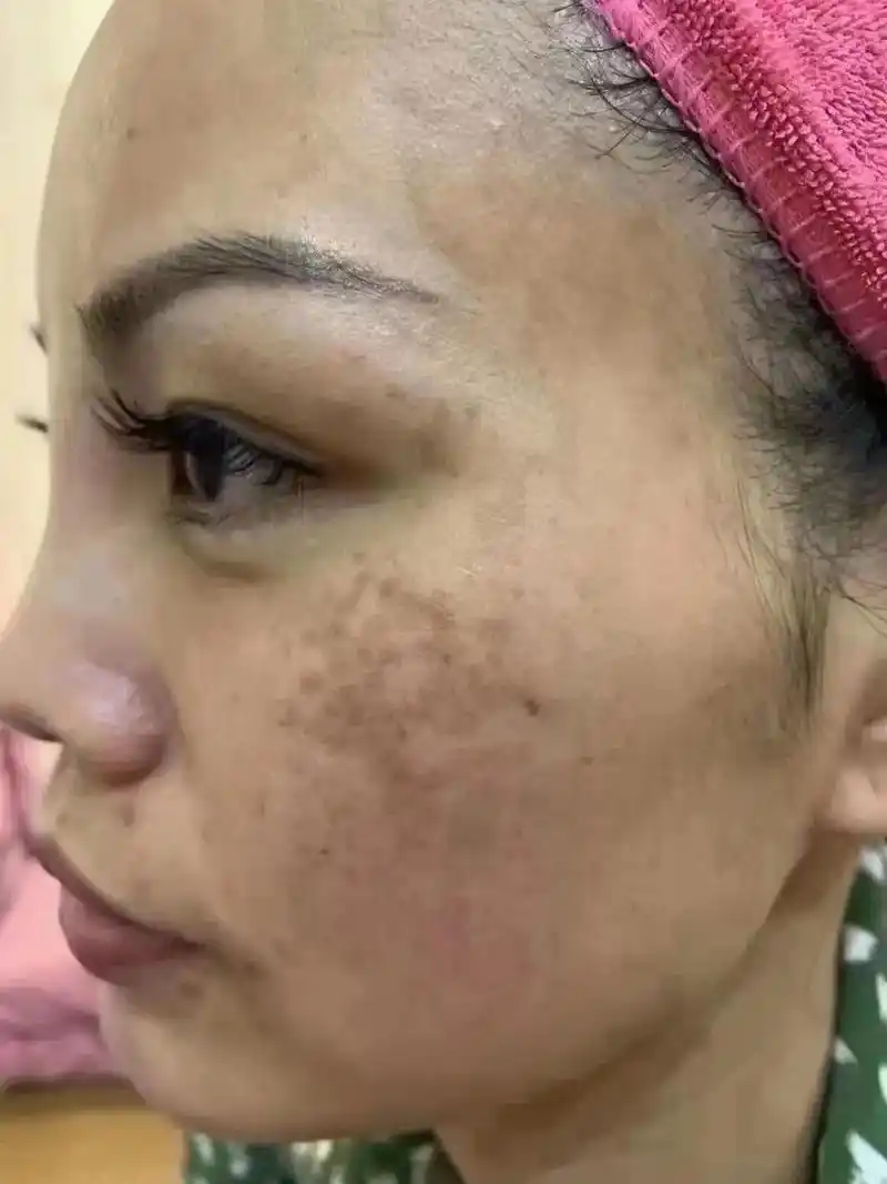 祛斑祛黄前后对比,年轻10岁.内黄同城##美白淡斑提亮肤色  - 抖音