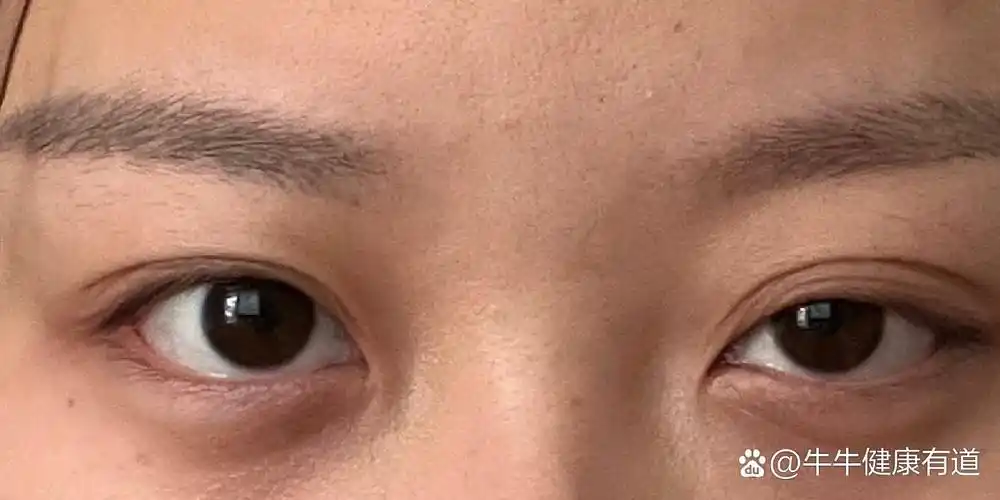 眼肌型重症肌无力病友求助