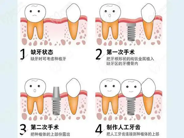 教训26岁做了种植牙我好后悔痛诉我种植牙5年后的感受