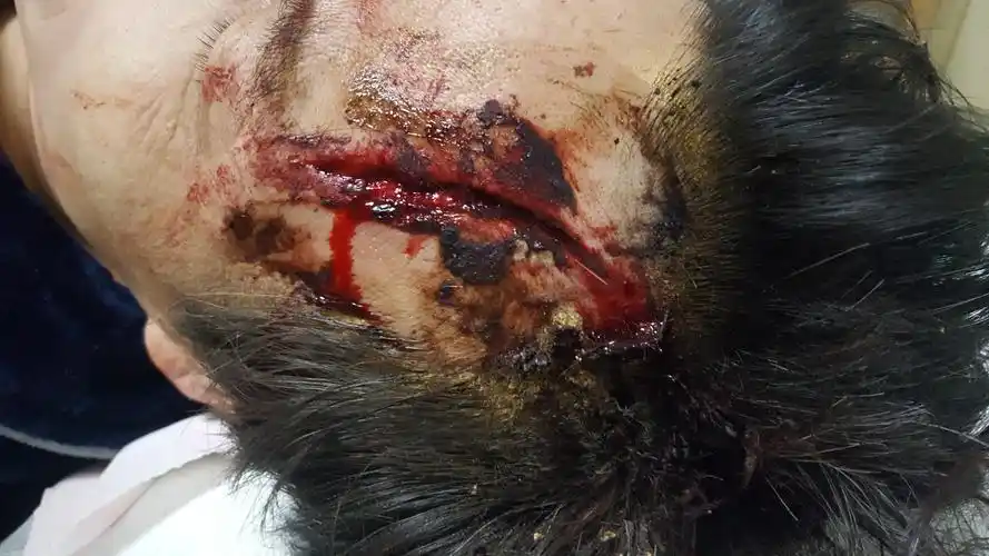 孩子头部磕流血了怎么办宝妈宝爸们一定要看原创