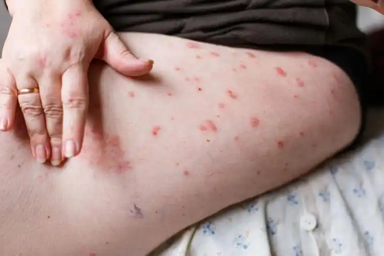 过敏症状是皮肤上有发红,发痒,风团,水疱,糜烂等症状.