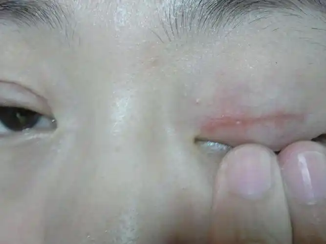 切开双眼皮手术后,线没拆干净,但是偶尔会有点刺痛,但是伤口已经长好