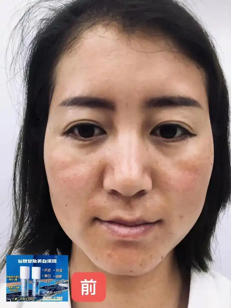 一套淡班后的反馈,皮肤细腻干净了,班点也淡化了,毛孔小了,皮 - 抖音