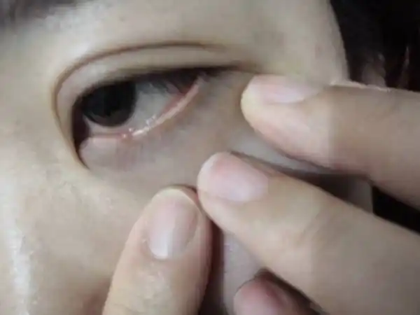 下眼皮长个小点,像小疙瘩似的,有时候磨眼睛,问大神是什么?怎么样除掉