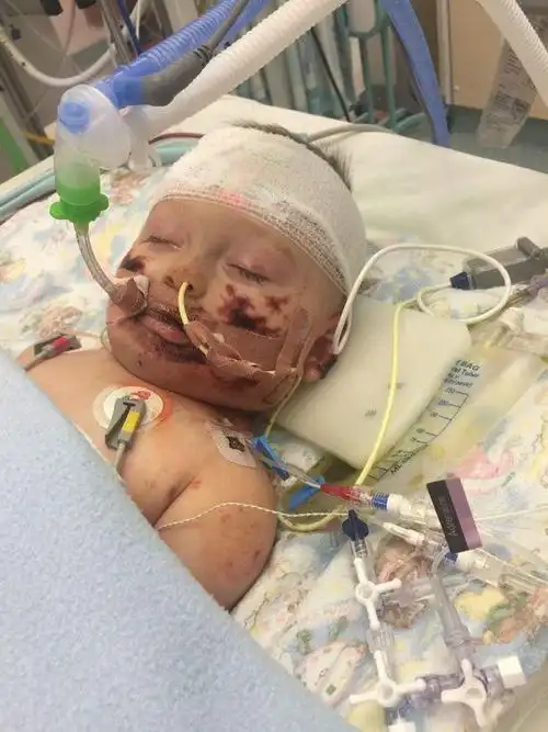 英国11月大宝宝因病截肢 微笑与命运抗争(图)