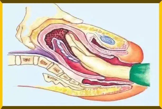 可 胎 儿 出 生,并 不 代 表 生 产 完 毕.