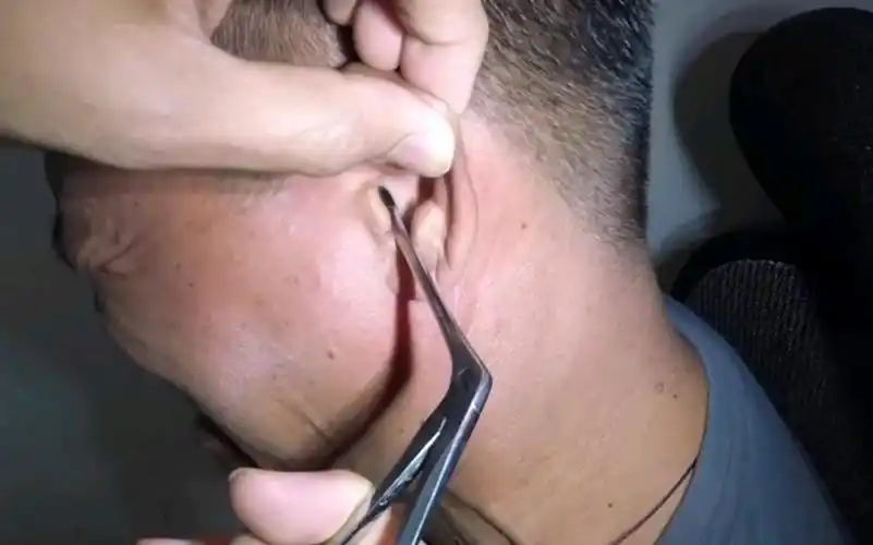 胆小者慎入,耳朵里面还有这个_哔哩哔哩 (゜-゜)つロ 干杯~-bilibili