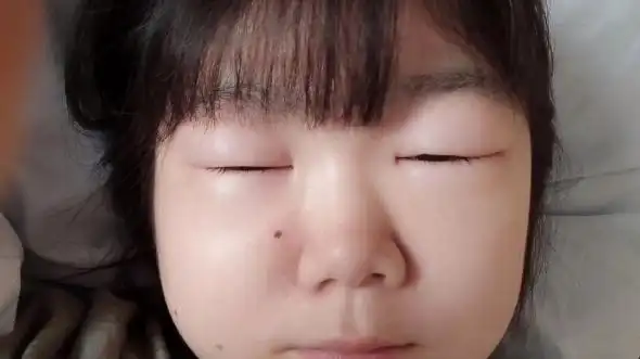 肾病综合征两年多,复发又一次肿成猪头啦