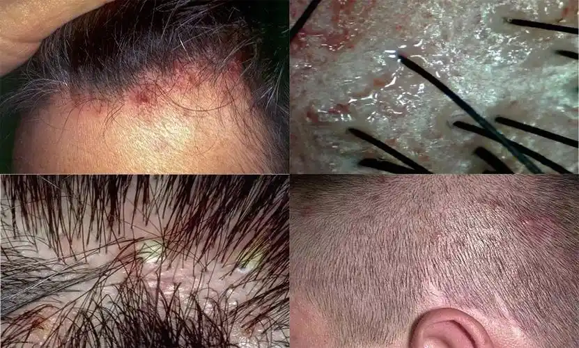 30万只螨虫在啃食你的头皮难怪头油脱发痒到抓狂