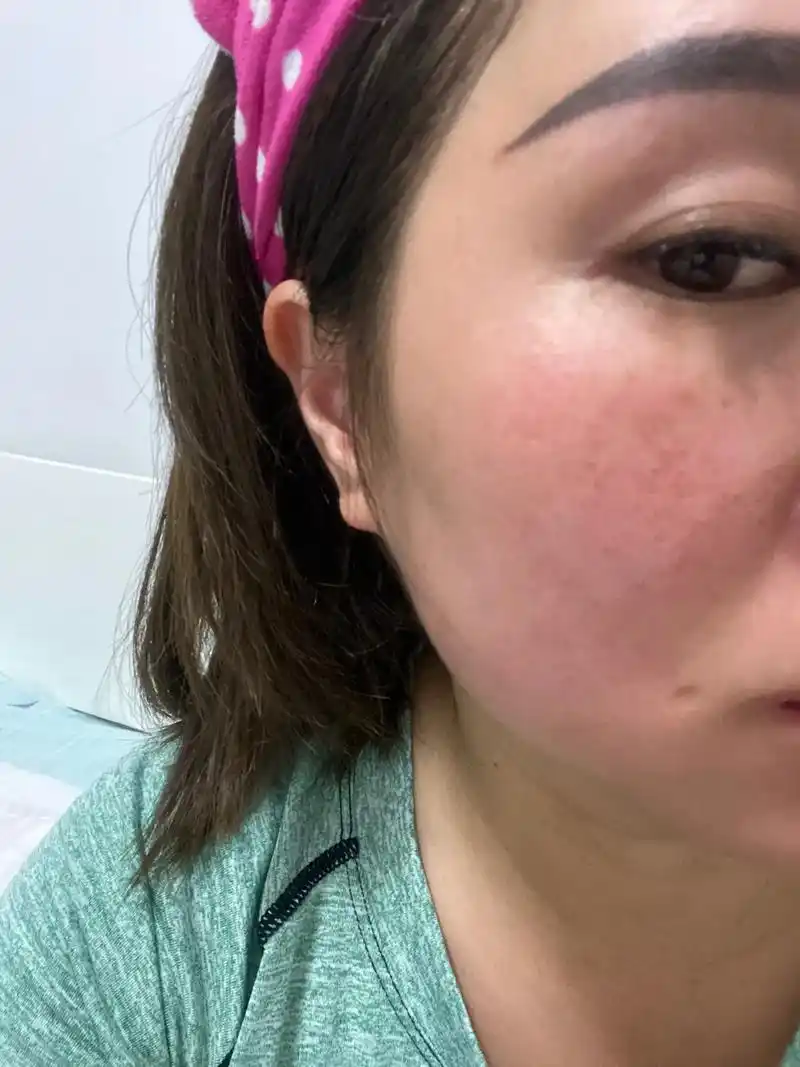 秋天换季皮肤缺水泛红敏感长痘 昨晚做了胶原外泌体一次效果 苹 - 抖