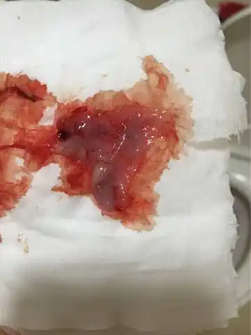 是自然流产还是生化妊娠?(慎!附排出物图片)