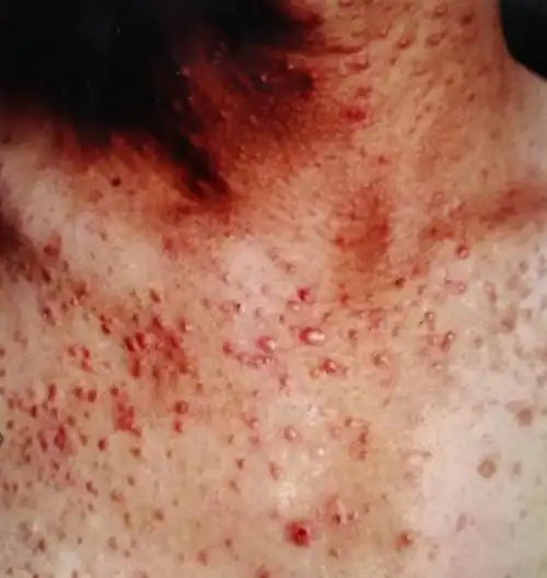 马拉色菌毛囊炎_毛囊炎_病因_预防_发病原因_如何预防 - 好大夫在线