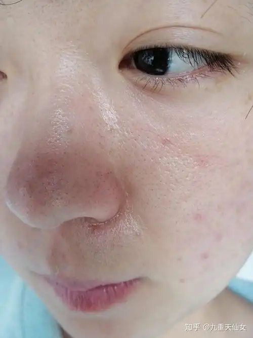 毛孔大,皮肤暗黄出油用什么护肤品好?