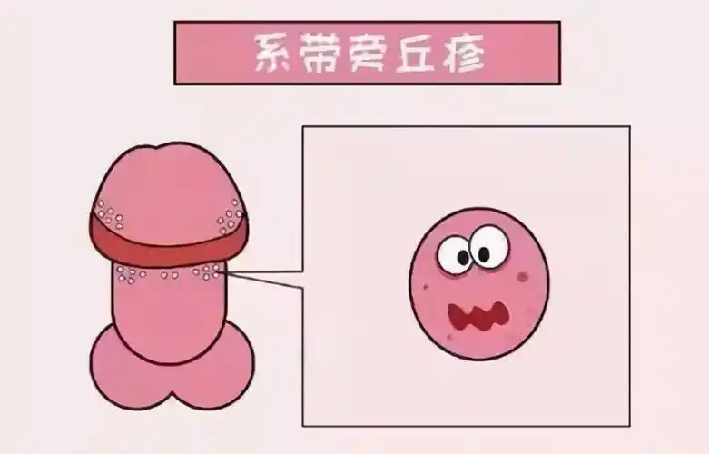 珍珠疹不痛不痒,主要发生在龟头的边缘与冠状沟交界处或系带处.