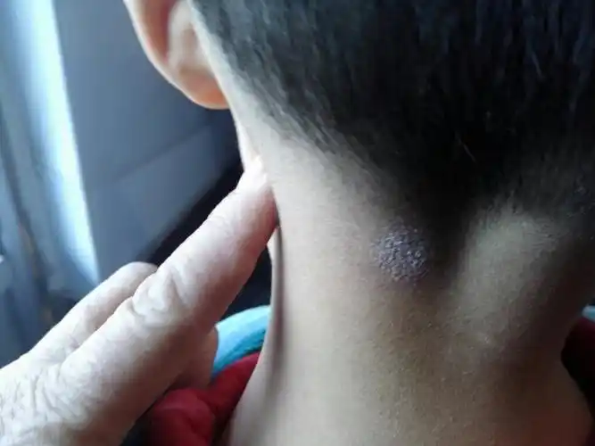 我想问一下大家孩子脖子后面长了一块黄色的跟癣一样的东西!