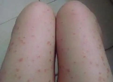 点状银屑病症状图片