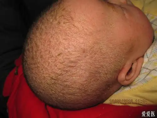 看图识病婴儿脂溢性皮炎