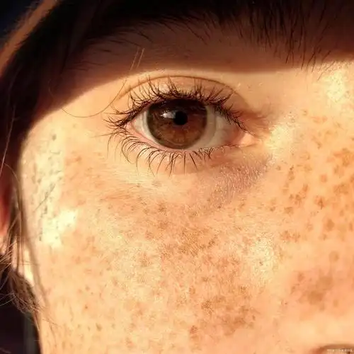 黄褐斑如何才能淡化?做什么项目好?