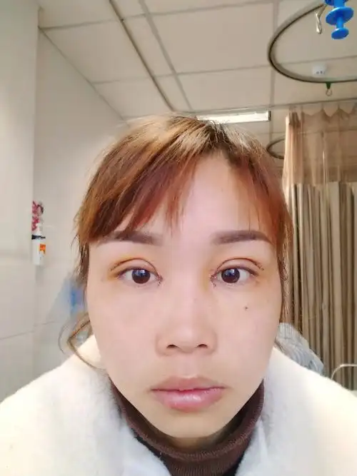 我的双眼皮是不是割的太宽了今天是做完双眼皮第6天感觉太奇怪了08