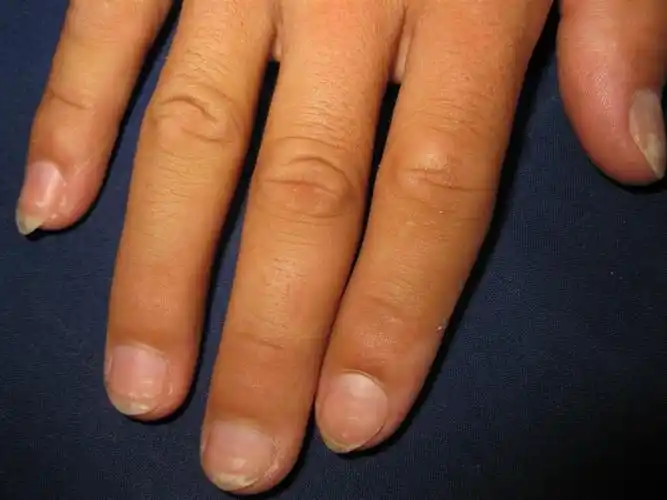 看图识病--------------点状白甲