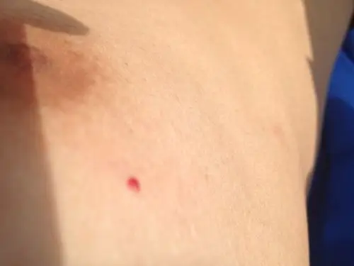 身上长了好几个红点血一样红,好几年了,不