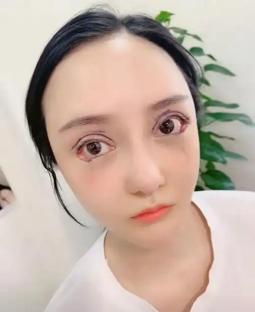 关于外眼角的秘密你清楚嘛,眼睑下至和开外眼角是一样_圈子-新氧美容