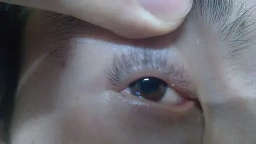 眼皮上长了一颗脂肪粒,怎么办跟图片一样