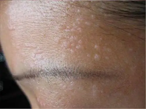 右脸的皮肤丝状疣的图片