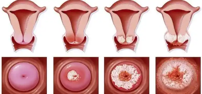妇科霉菌感染是怎么引起的(妇科霉菌用什么药比较好)