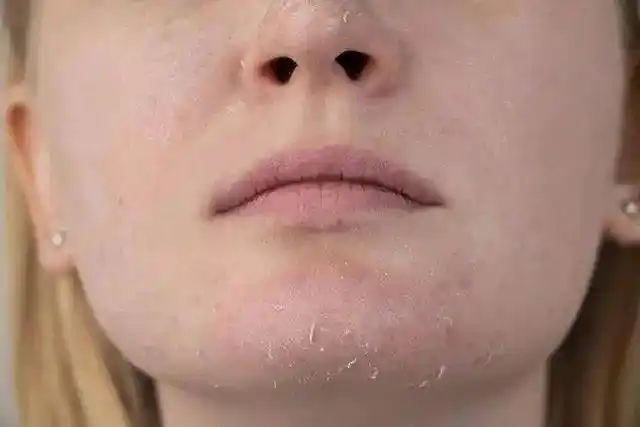 皮肤不仅开始变得更加干燥,而且会出现全身皮肤发紧,脱皮和发痒的状况