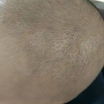 宝贝这段时间头上脱皮,求解_宝宝树