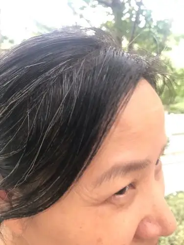 家族遗传白发 ——营养性代谢性白发