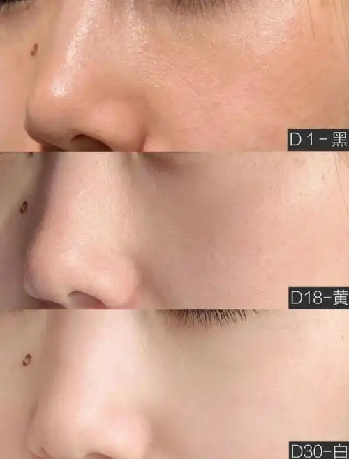 溶脂针,一种受欢迎但存在风险的医美项目,理性追求,保持警惕