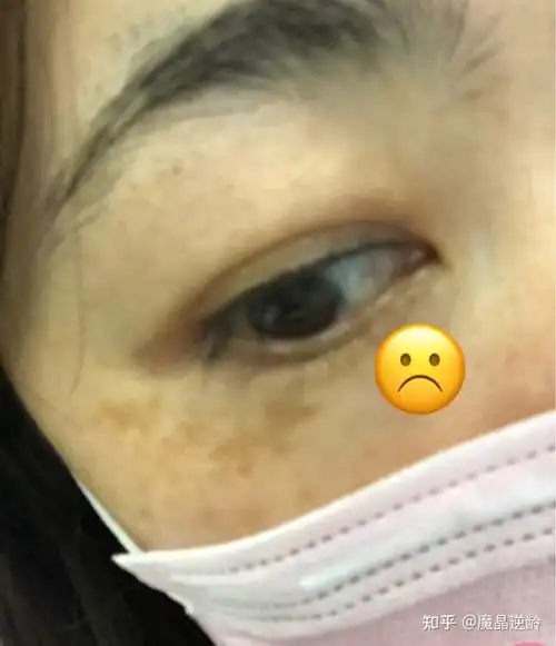 脸上长了黄褐斑,好难受!怎么才能去掉啊? ?