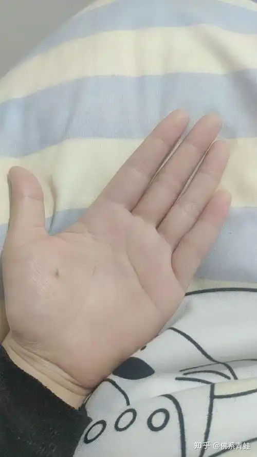 手掌心有痣
