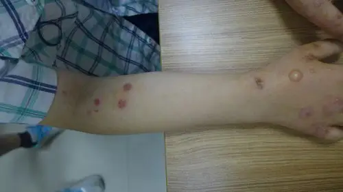 儿童疱疹样皮炎如何治疗