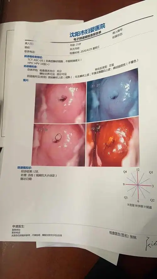 宫颈癌前病变hpv16