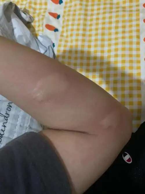 咬这么大的包不敢相信,不光痒痒还有点刺挠,拍死的蚊子一肚子血最新